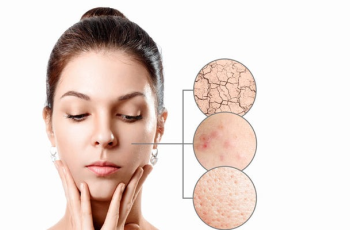 Can You Use Azelaic Acid Daily for Six Months?