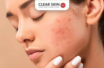 Your Ultimate Skincare Journey to Defeat Acne and Heal Marks